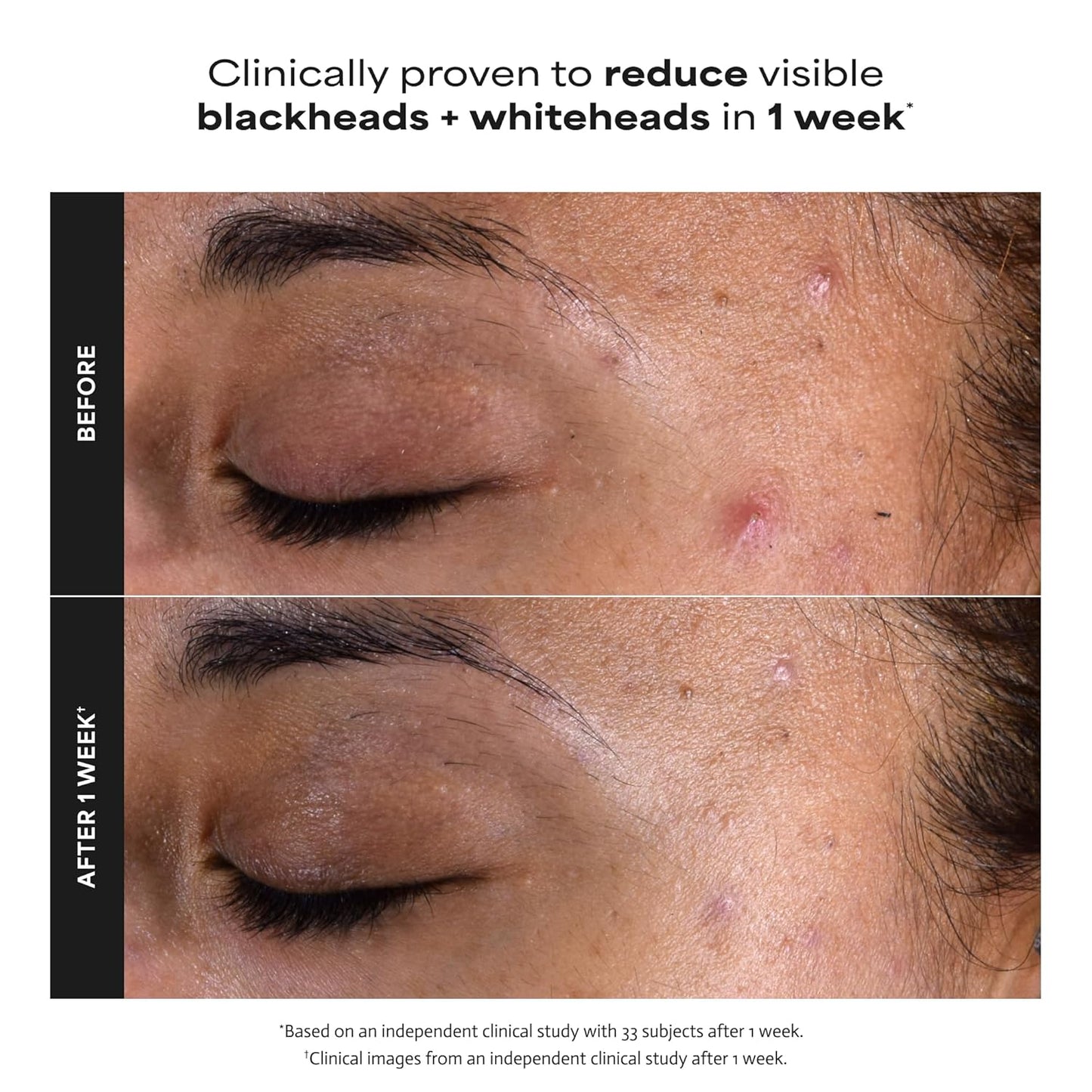 Paula's Choice SKIN PERFECTING 2% BHA Liquid Exfoliant with Salicylic Acid, Facial Polish for Enlarged Pores, Wrinkles & Fine