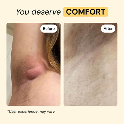 MyMagicHealer Universal Flare Care Multi-Purpose Solution, Skin Flare-Ups - Hidradenitis Suppurativa, Folliculitis, Boils, Cysts