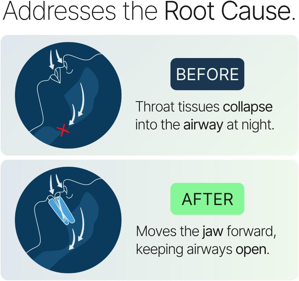 Somnofit-S Anti-Snore Mouth Guard by SnoreLessNow, Made in Switzerland, FDA Cleared, Most Comfortable Anti Snoring