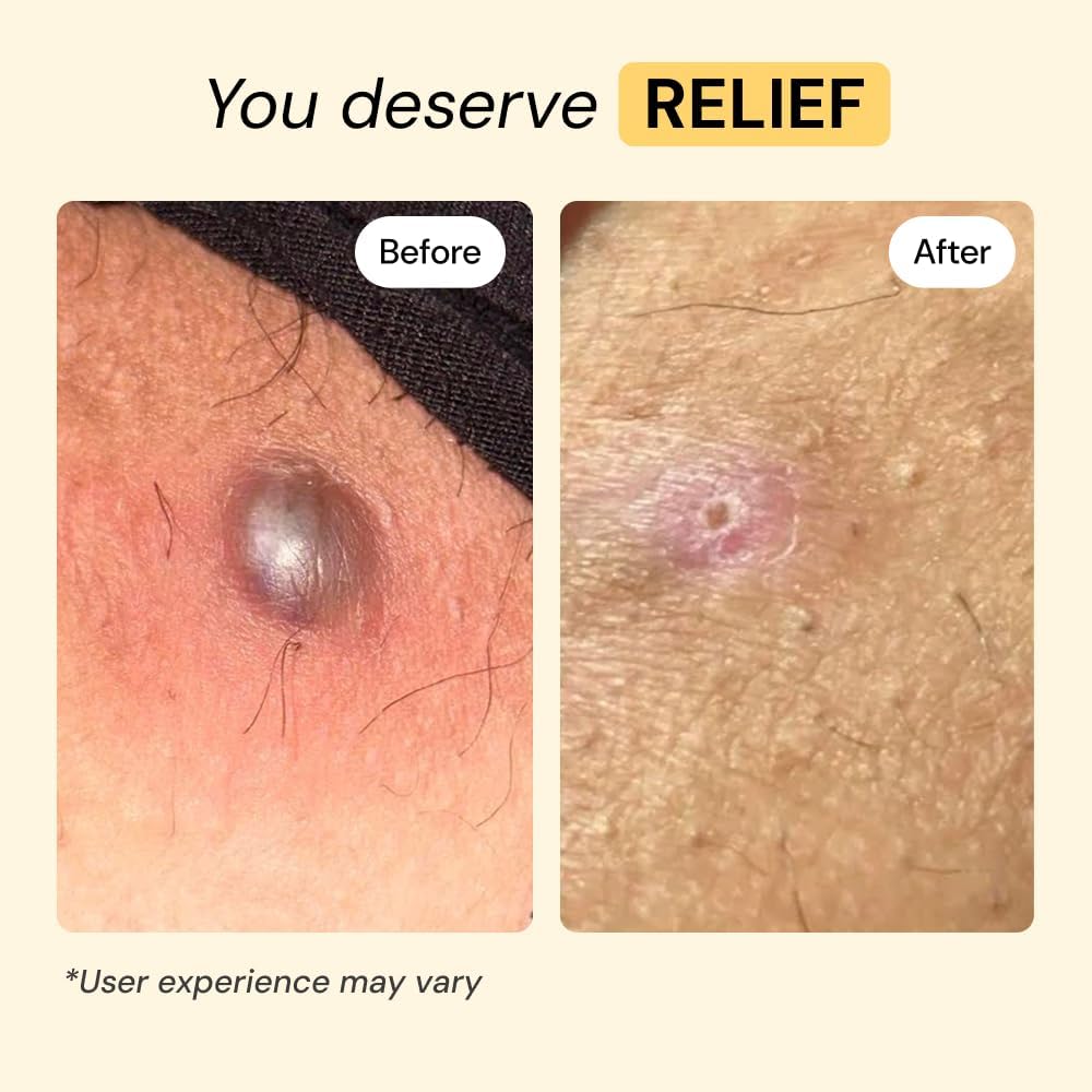 MyMagicHealer Universal Flare Care Multi-Purpose Solution, Skin Flare-Ups - Hidradenitis Suppurativa, Folliculitis, Boils, Cysts