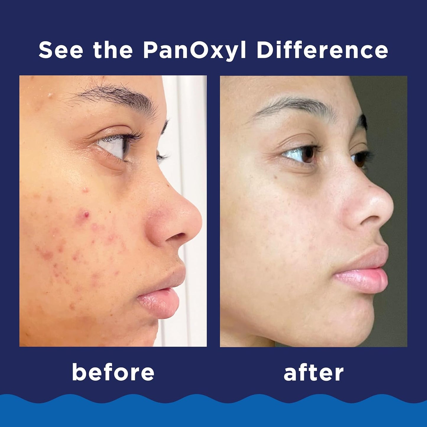 PanOxyl 10% Benzoyl Peroxide Acne Foaming Wash, Maximum Strength, Daily Acne-Fighting Face and Body Cleanser, Face Wash to