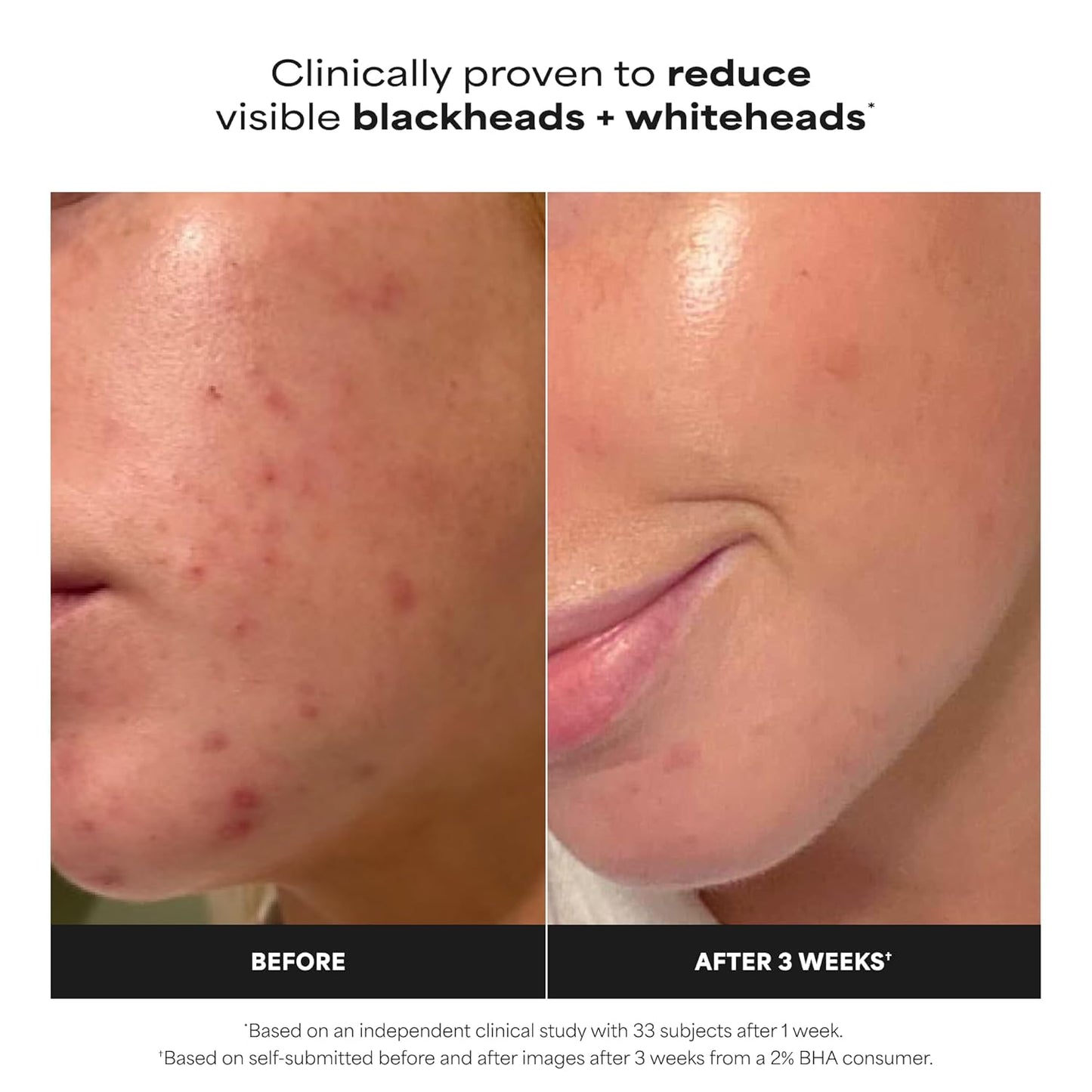 Paula's Choice SKIN PERFECTING 2% BHA Liquid Exfoliant with Salicylic Acid, Facial Polish for Enlarged Pores, Wrinkles & Fine