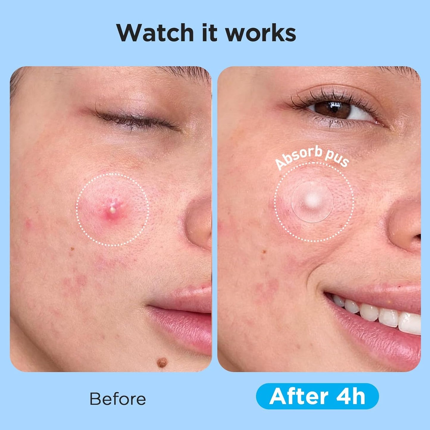 Pimple Patches for Face (504 Count), FSA Eligible Acne Patch Bulk, Zit Stickers 4 Sizes, Hydrocolloid Spot