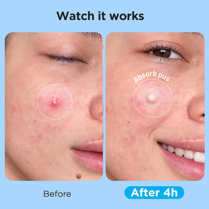 Pimple Patches for Face (504 Count), FSA Eligible Acne Patch Bulk, Zit Stickers 4 Sizes, Hydrocolloid Spot