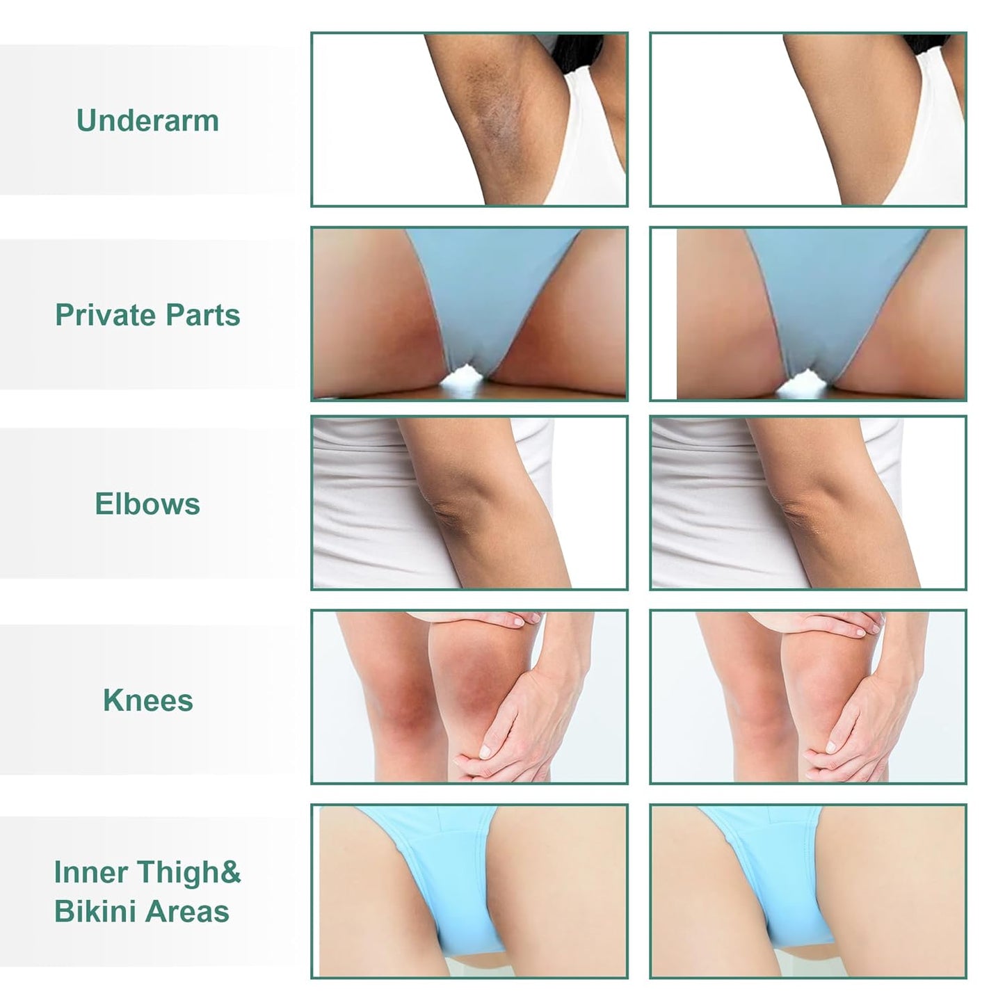 Skin Bleaching Cream Skin Lightening for Body Intimate Areas, Private Parts, Underarm, Knees, Elbows, Inner Thigh, Bikini