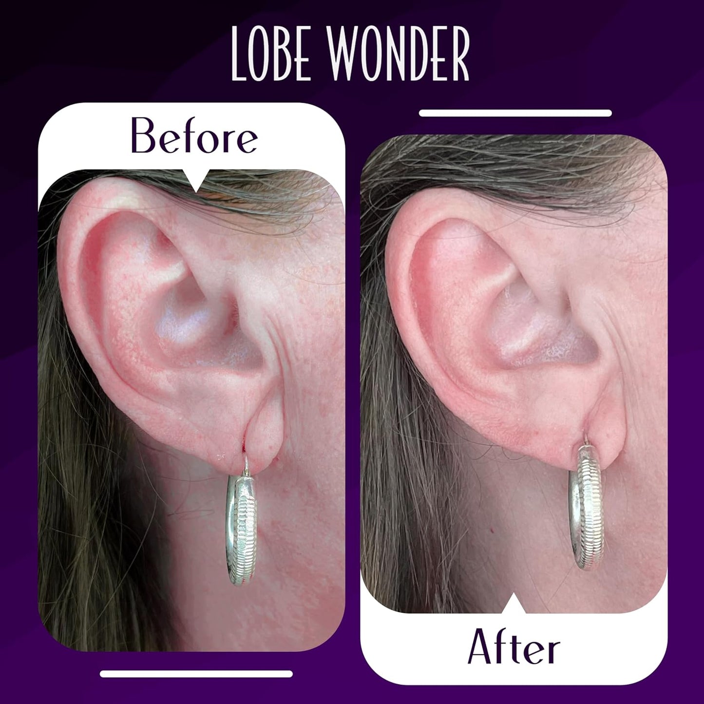 Lobe Wonder - The ORIGINAL Ear Lobe Support Patch for Pierced Ears - Eliminates the Look of Torn or Stretched Piercings - Protects Healthy Ear Lobes