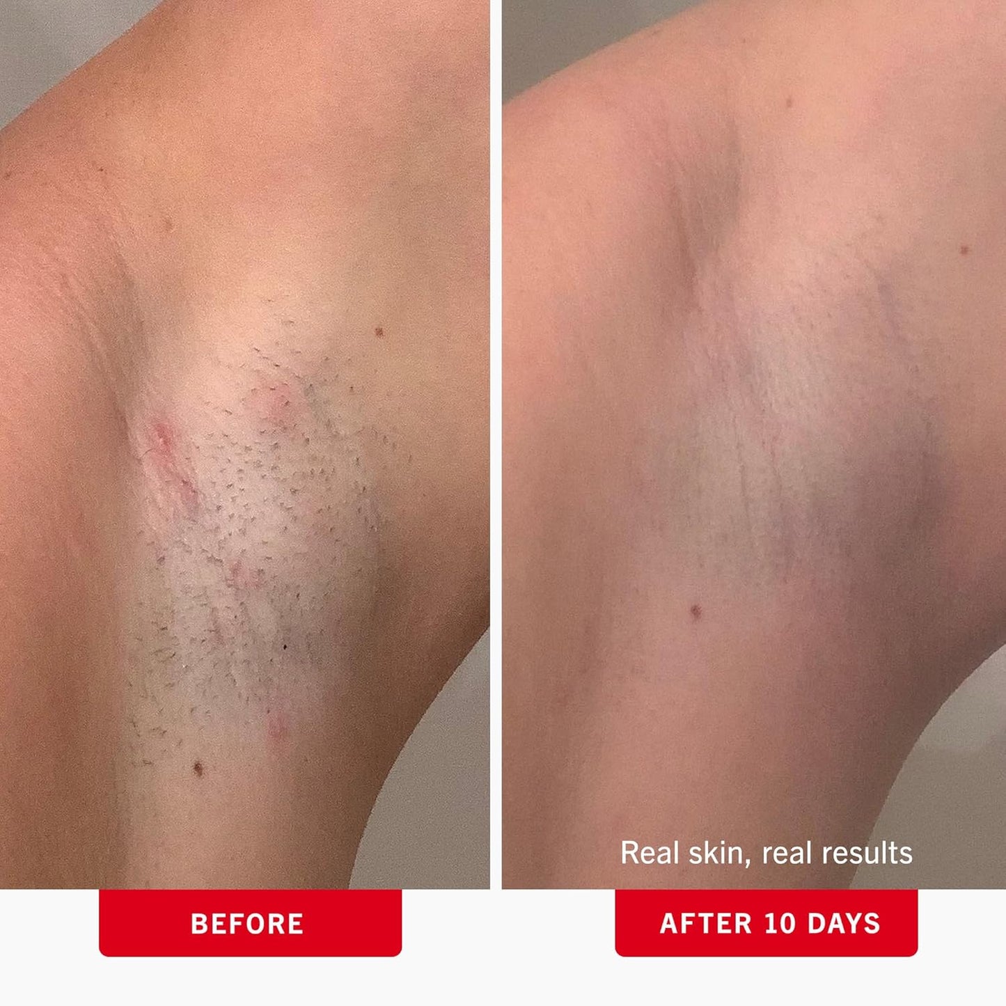 First Aid Beauty - Ingrown Hair Pads with BHA + AHA - Aftershave Treatment Pads to Help Prevent Razor Bumps for Men & Women - Exfoliate Underarms &