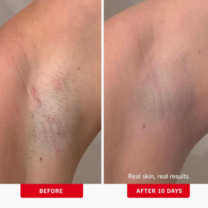 First Aid Beauty - Ingrown Hair Pads with BHA + AHA - Aftershave Treatment Pads to Help Prevent Razor Bumps for Men & Women - Exfoliate Underarms &