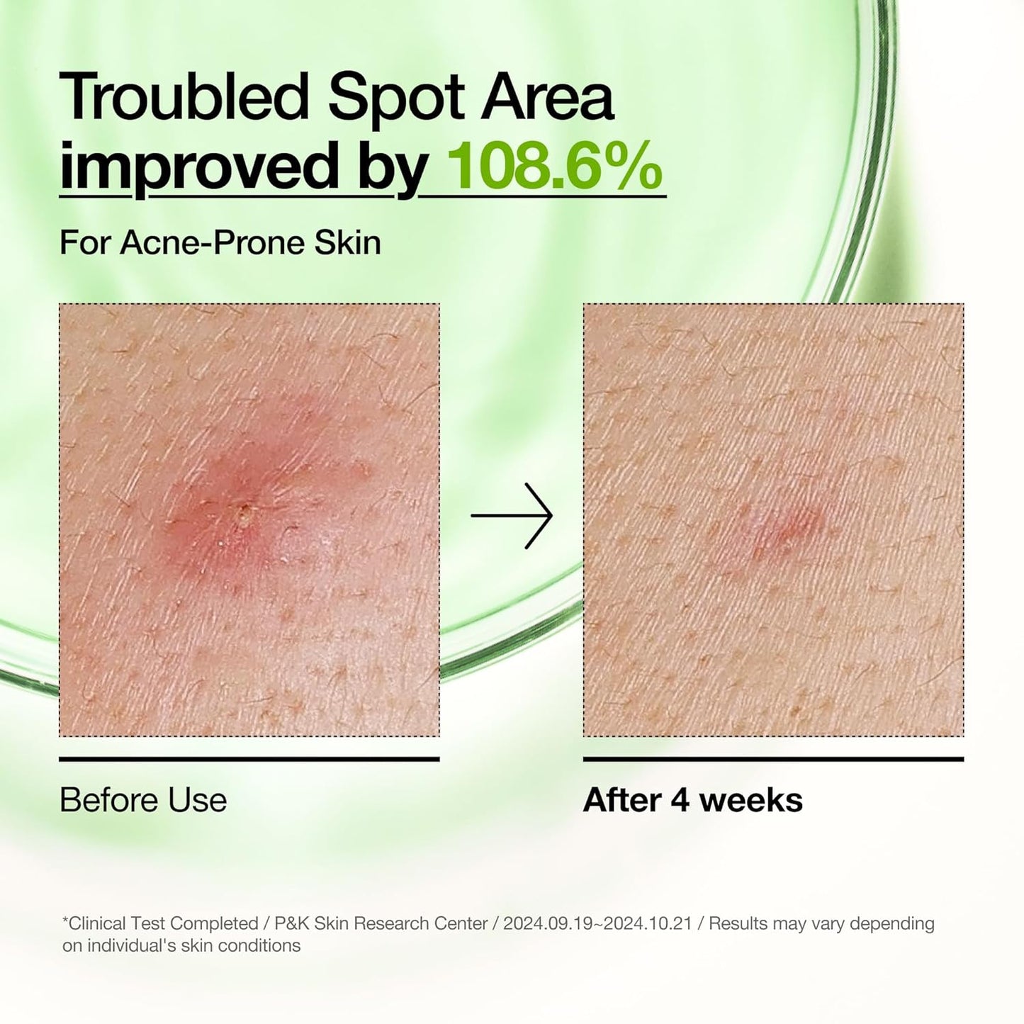 Anua Azelaic Acid 10 Hyaluron Redness Soothing Serum, Facial Serum for Blemish-Prone & Oily-Prone Skin, Lightweight & Hydrating Blemish