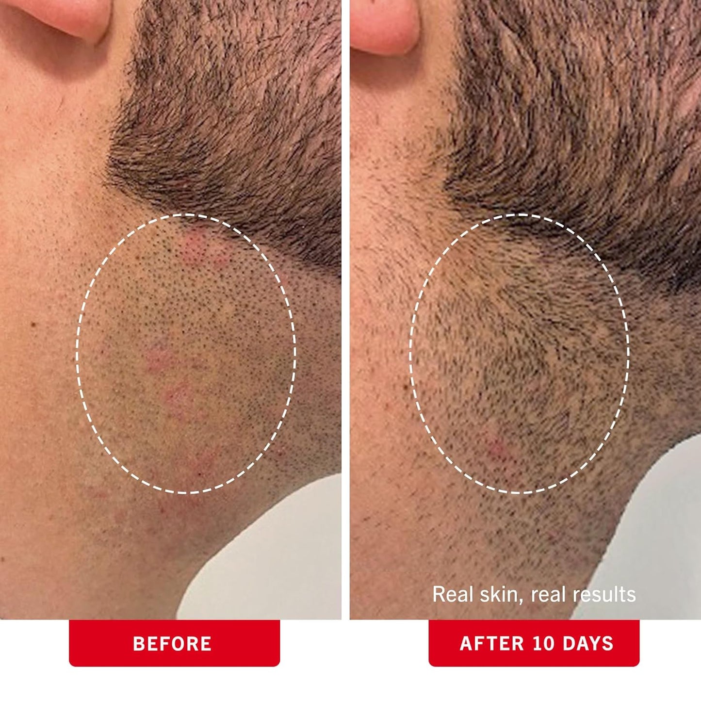 First Aid Beauty - Ingrown Hair Pads with BHA + AHA - Aftershave Treatment Pads to Help Prevent Razor Bumps for Men & Women - Exfoliate Underarms &