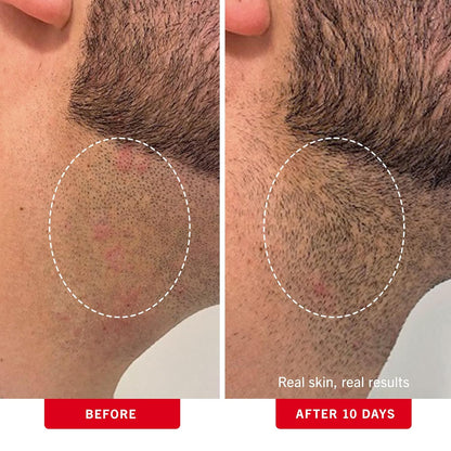 First Aid Beauty - Ingrown Hair Pads with BHA + AHA - Aftershave Treatment Pads to Help Prevent Razor Bumps for Men & Women - Exfoliate Underarms &